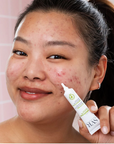 SEBIACLEAR CICAPEEL CORRECTOR PARA ACNE 40 ML